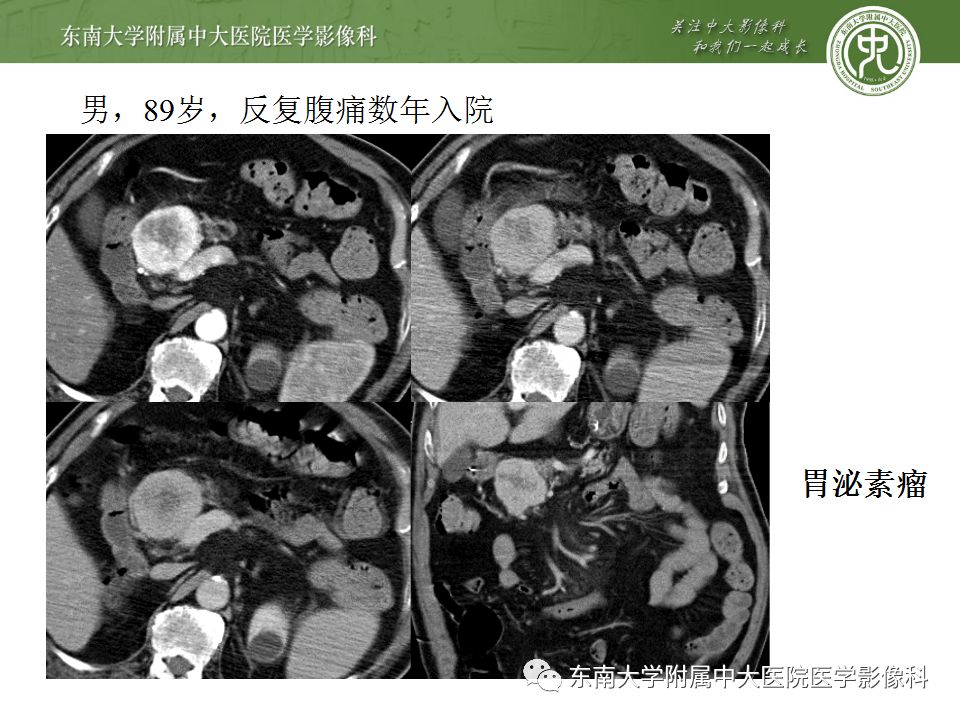 影像PPT - 【病例】胰腺神经内分泌癌1例CT影像-17