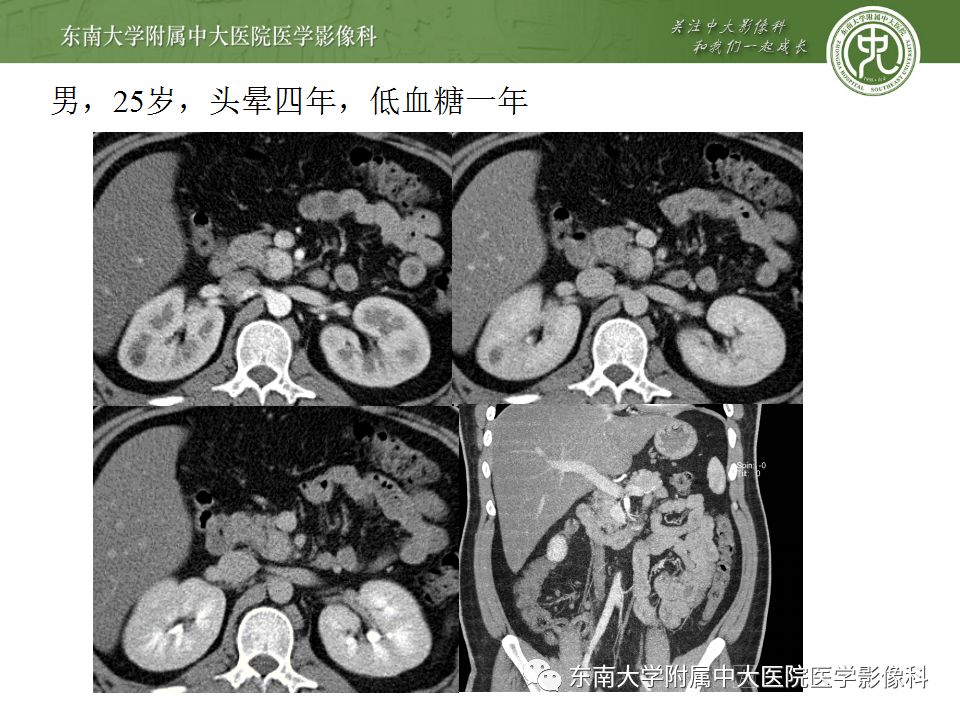 影像PPT - 【病例】胰腺神经内分泌癌1例CT影像-18
