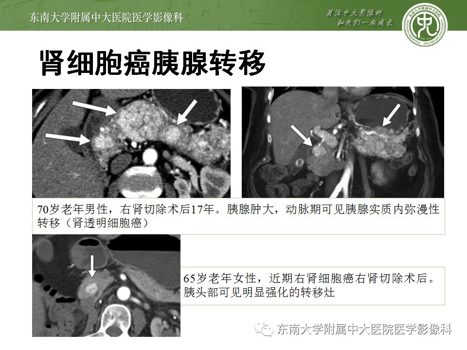 影像PPT - 【病例】胰腺神经内分泌癌1例CT影像-21