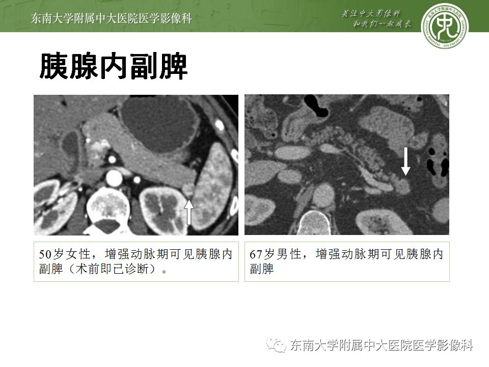 影像PPT - 【病例】胰腺神经内分泌癌1例CT影像-23