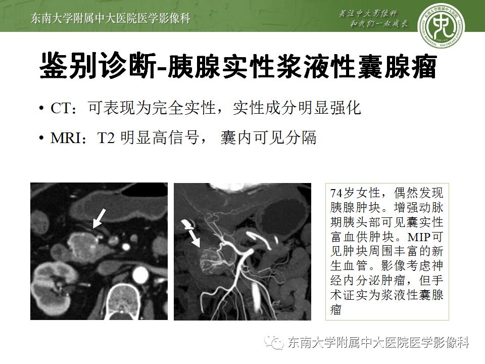 影像PPT - 【病例】胰腺神经内分泌癌1例CT影像-24