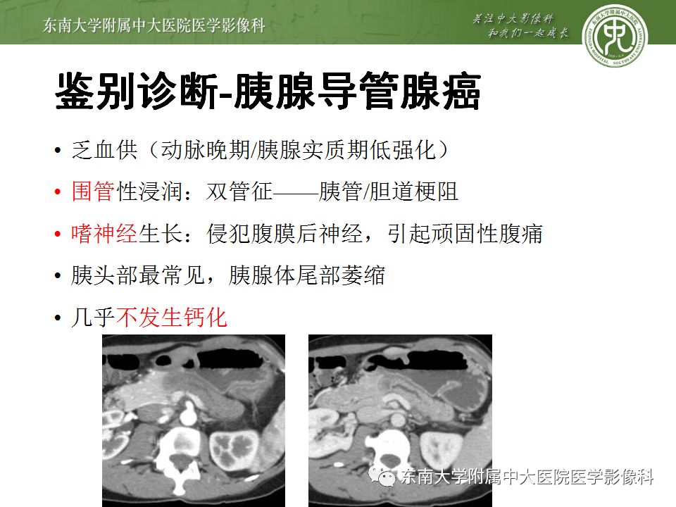影像PPT - 【病例】胰腺神经内分泌癌1例CT影像-25