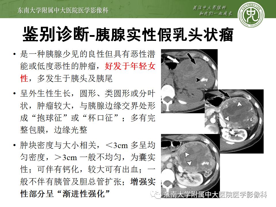 影像PPT - 【病例】胰腺神经内分泌癌1例CT影像-26