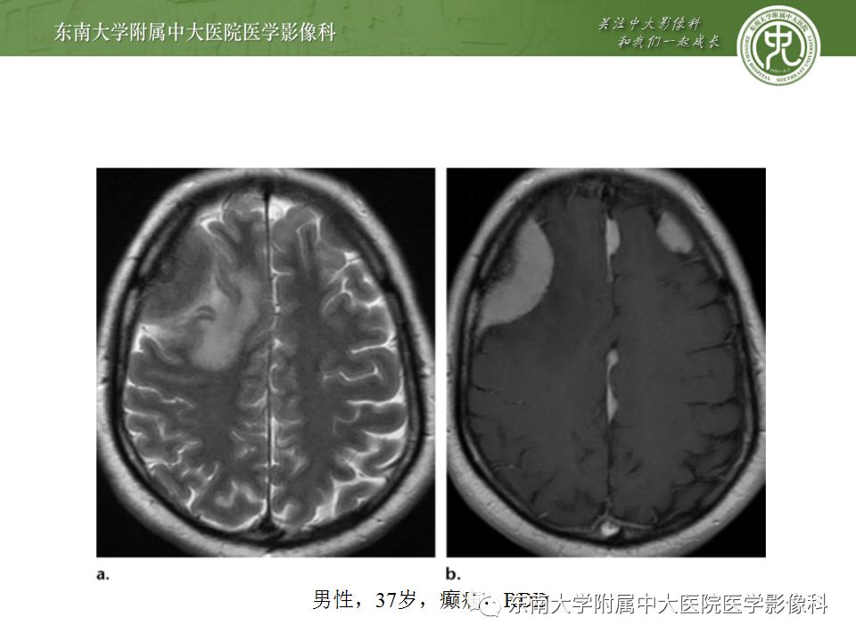 影像PPT - 【病例】罗道病1例MR影像-11