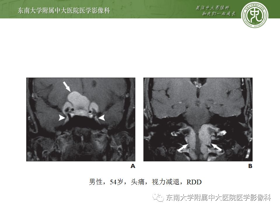 影像PPT - 【病例】罗道病1例MR影像-12