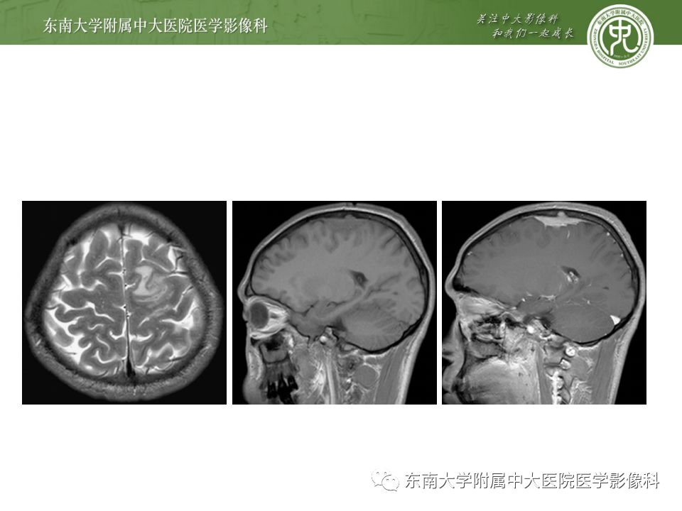 影像PPT - 【病例】罗道病1例MR影像-13