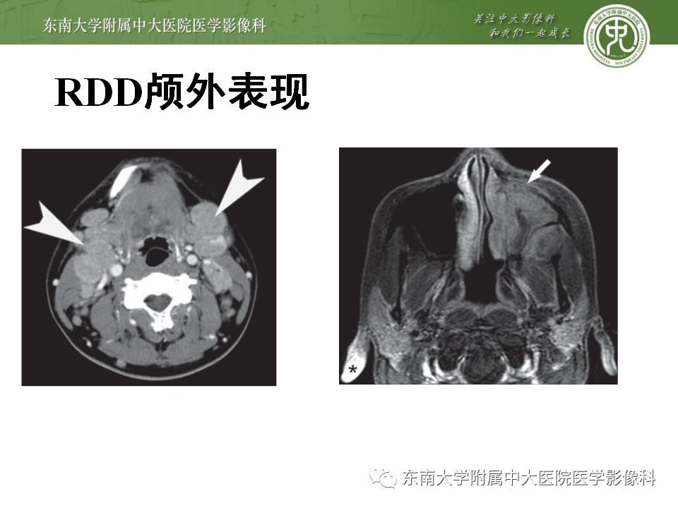 影像PPT - 【病例】罗道病1例MR影像-14