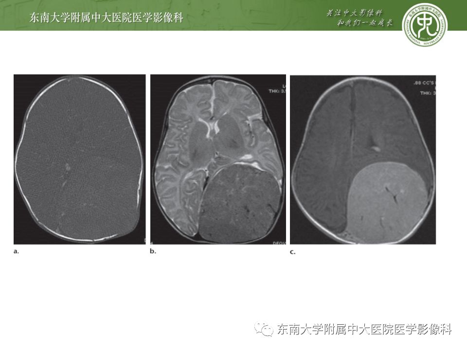 影像PPT - 【病例】罗道病1例MR影像-18