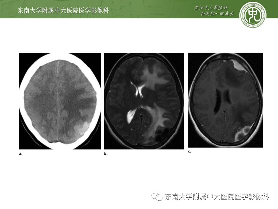 影像PPT - 【病例】罗道病1例MR影像-21