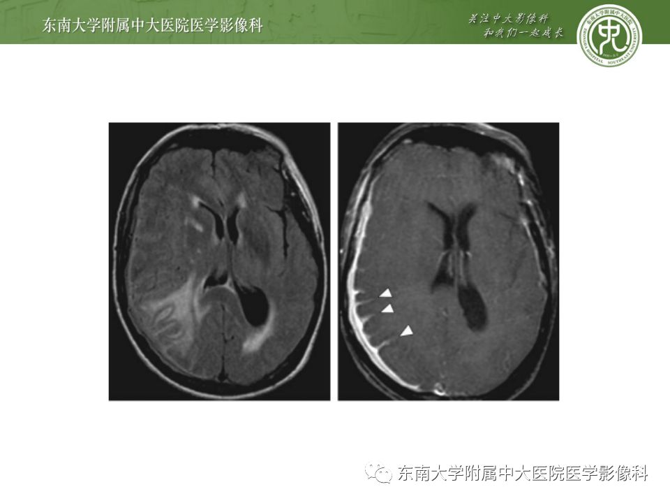 影像PPT - 【病例】罗道病1例MR影像-22