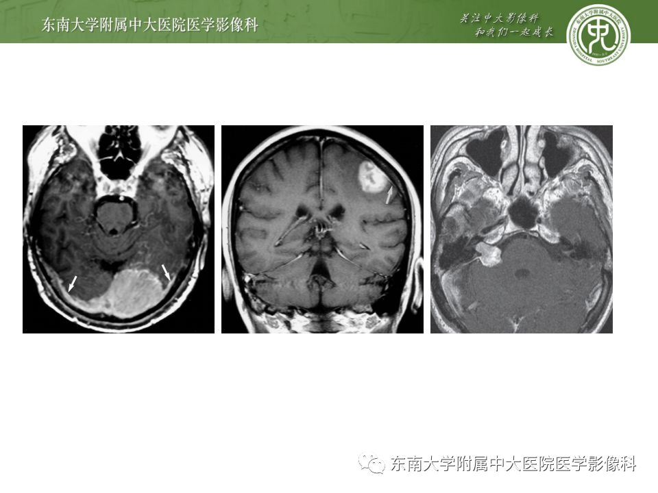 影像PPT - 【病例】罗道病1例MR影像-25