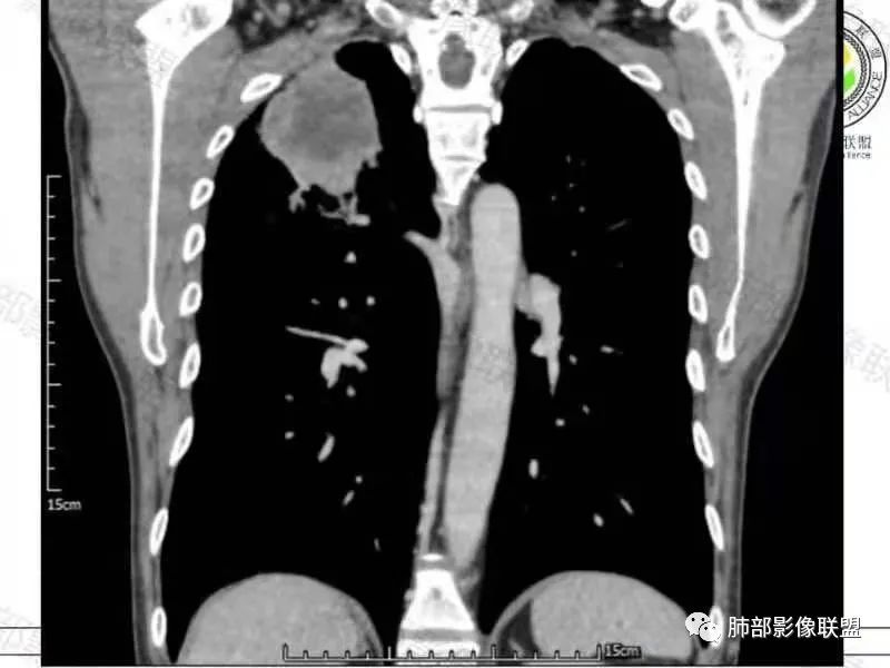 影像PPT - 【病例】肺部马尔尼菲青霉菌病1例CT影像讨论-22 影像PPT - 【病例】肺部马尔尼菲青霉菌病1例CT影像讨论-22