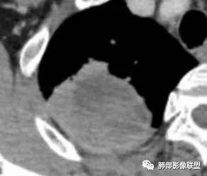 影像PPT - 【病例】肺部马尔尼菲青霉菌病1例CT影像讨论-23 影像PPT - 【病例】肺部马尔尼菲青霉菌病1例CT影像讨论-23