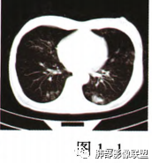 影像PPT - 【病例】肺部马尔尼菲青霉菌病1例CT影像讨论-28 影像PPT - 【病例】肺部马尔尼菲青霉菌病1例CT影像讨论-28