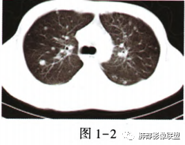 影像PPT - 【病例】肺部马尔尼菲青霉菌病1例CT影像讨论-29 影像PPT - 【病例】肺部马尔尼菲青霉菌病1例CT影像讨论-29