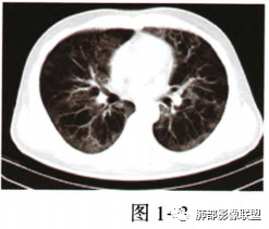 影像PPT - 【病例】肺部马尔尼菲青霉菌病1例CT影像讨论-30 影像PPT - 【病例】肺部马尔尼菲青霉菌病1例CT影像讨论-30