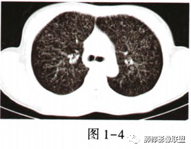 影像PPT - 【病例】肺部马尔尼菲青霉菌病1例CT影像讨论-31 影像PPT - 【病例】肺部马尔尼菲青霉菌病1例CT影像讨论-31