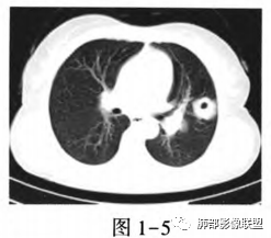 影像PPT - 【病例】肺部马尔尼菲青霉菌病1例CT影像讨论-32 影像PPT - 【病例】肺部马尔尼菲青霉菌病1例CT影像讨论-32