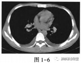 影像PPT - 【病例】肺部马尔尼菲青霉菌病1例CT影像讨论-33 影像PPT - 【病例】肺部马尔尼菲青霉菌病1例CT影像讨论-33