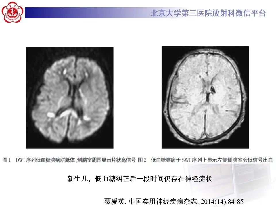 影像PPT - 【PPT】新生儿低血糖脑病影像表现-17