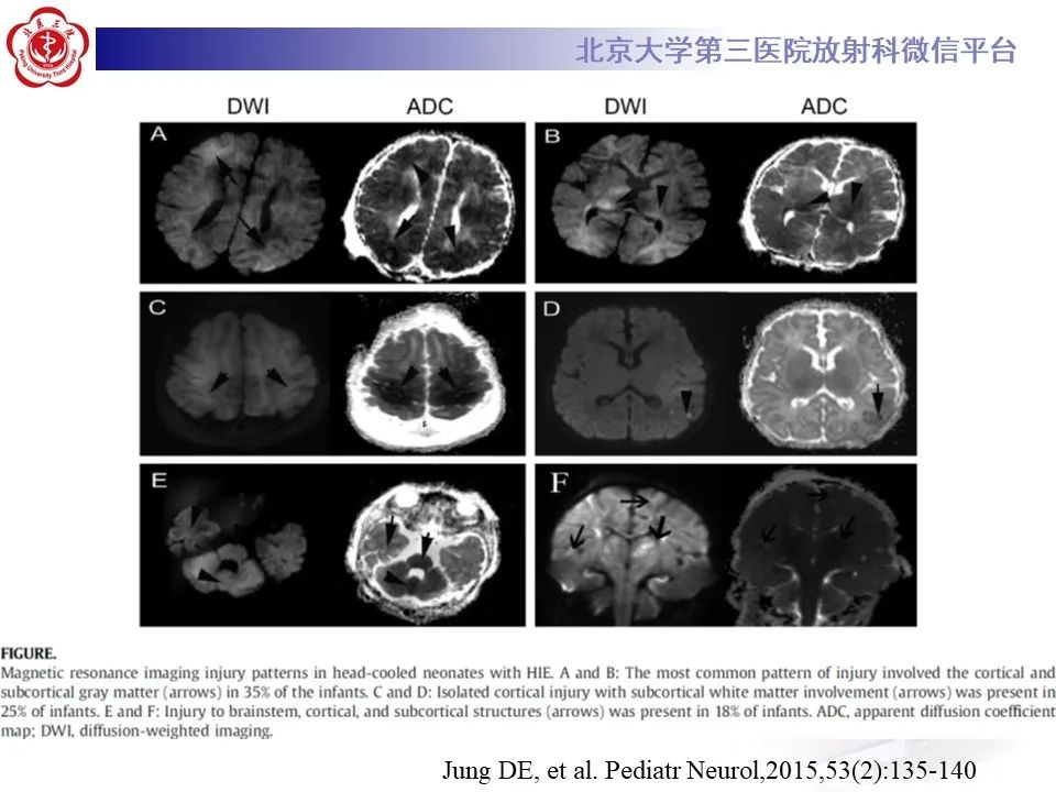 影像PPT - 【PPT】新生儿低血糖脑病影像表现-25