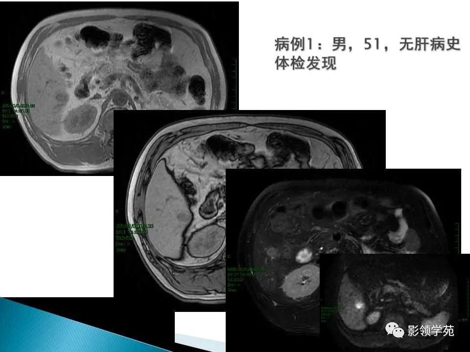 影像PPT - 【PPT】HCC影像诊断进展-2