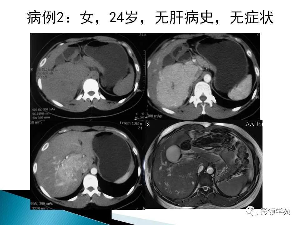 影像PPT - 【PPT】HCC影像诊断进展-4