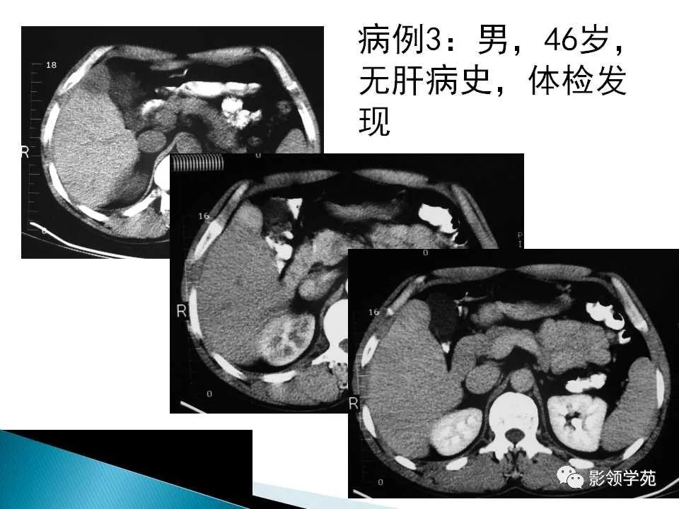 影像PPT - 【PPT】HCC影像诊断进展-5