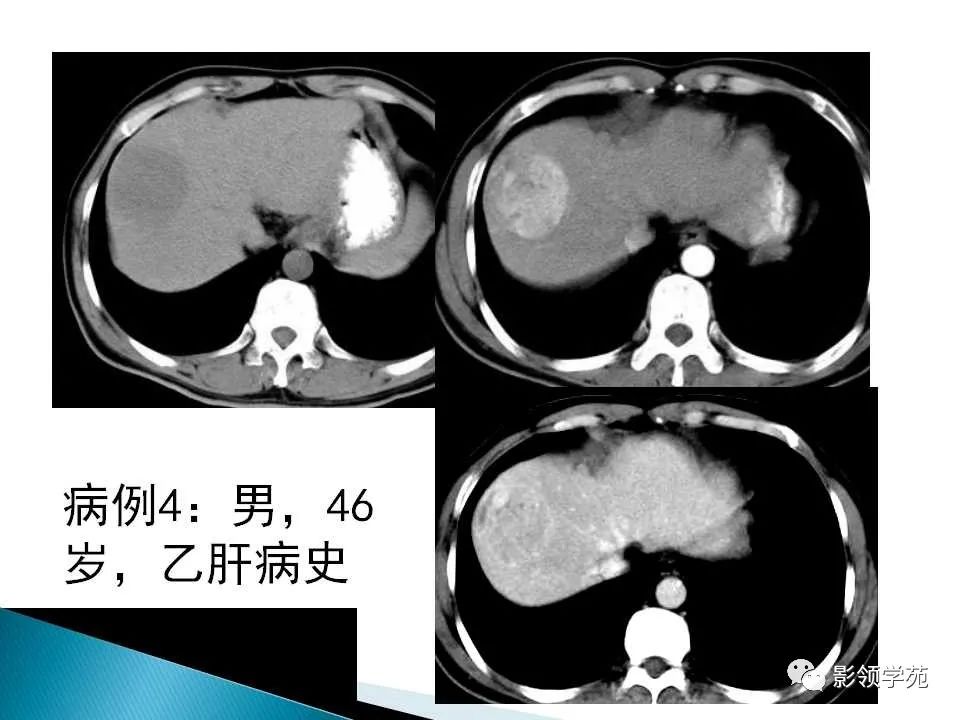 影像PPT - 【PPT】HCC影像诊断进展-6