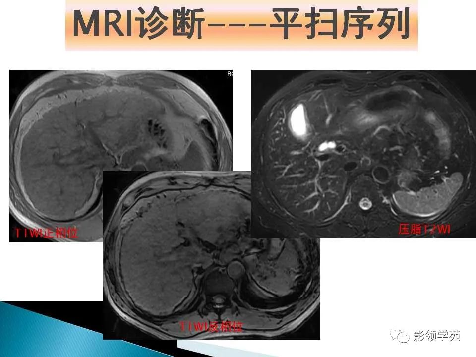 影像PPT - 【PPT】HCC影像诊断进展-13