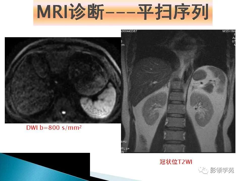 影像PPT - 【PPT】HCC影像诊断进展-14
