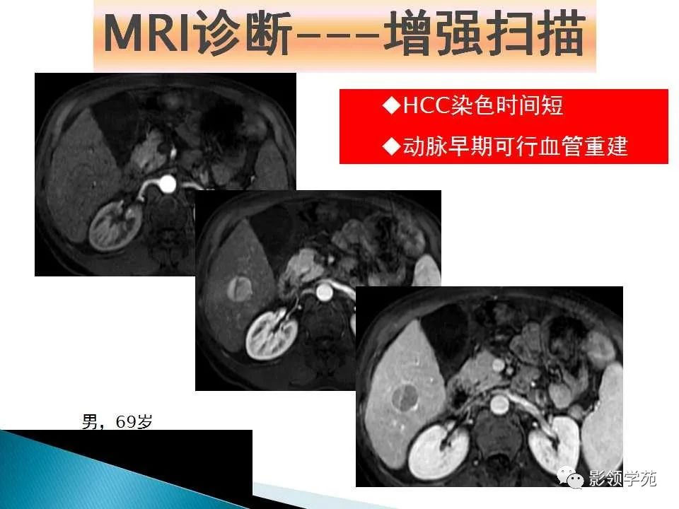影像PPT - 【PPT】HCC影像诊断进展-15