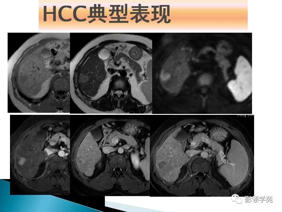 影像PPT - 【PPT】HCC影像诊断进展-17