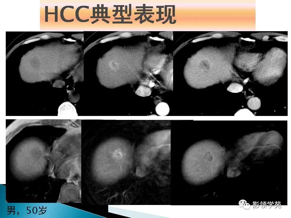 影像PPT - 【PPT】HCC影像诊断进展-18