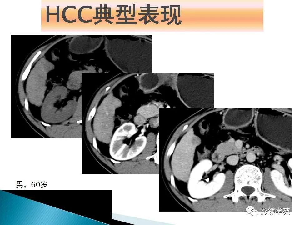 影像PPT - 【PPT】HCC影像诊断进展-19