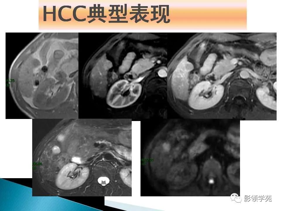 影像PPT - 【PPT】HCC影像诊断进展-20