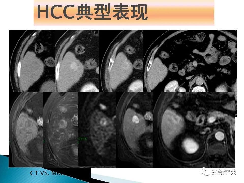 影像PPT - 【PPT】HCC影像诊断进展-21