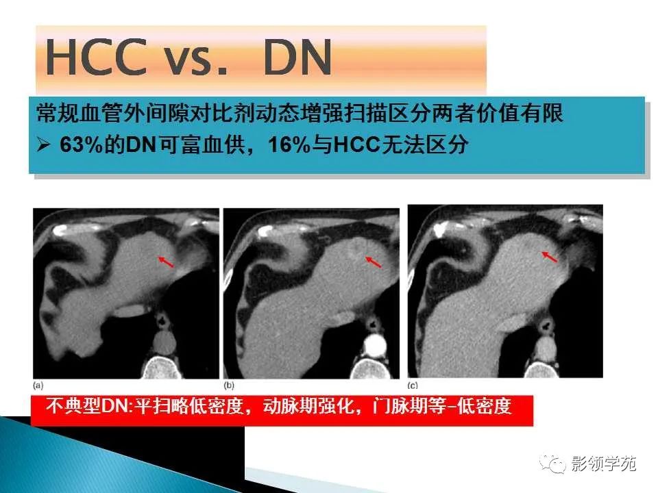 影像PPT - 【PPT】HCC影像诊断进展-25