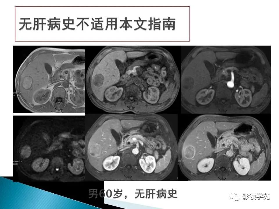 影像PPT - 【PPT】HCC影像诊断进展-29