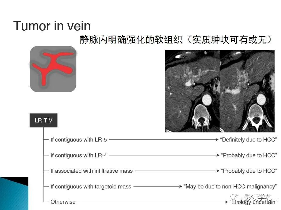 影像PPT - 【PPT】HCC影像诊断进展-32