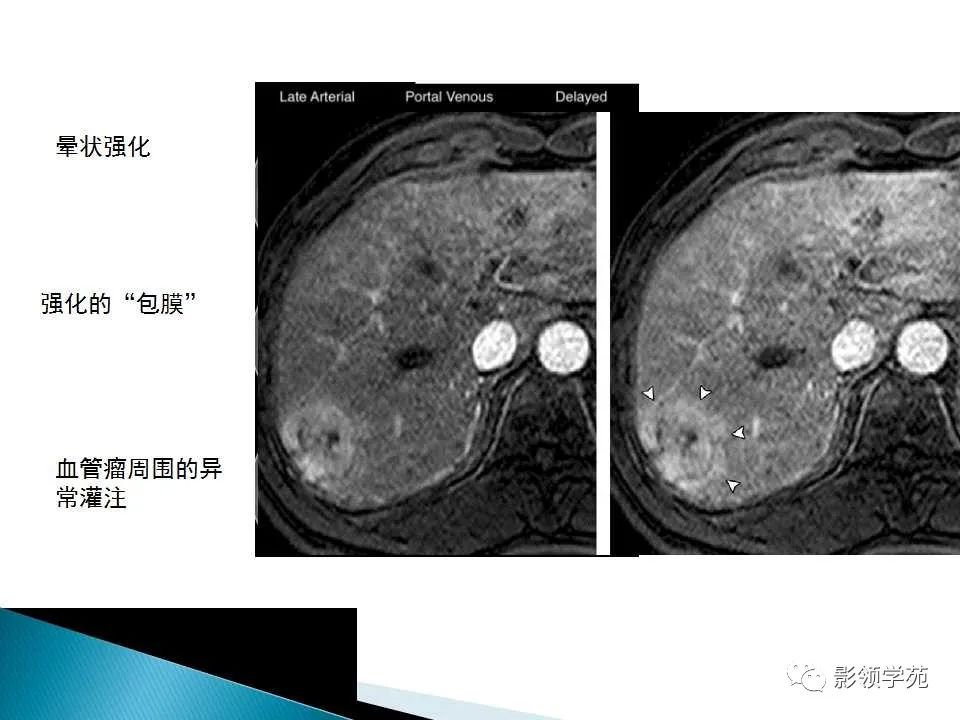 影像PPT - 【PPT】HCC影像诊断进展-45