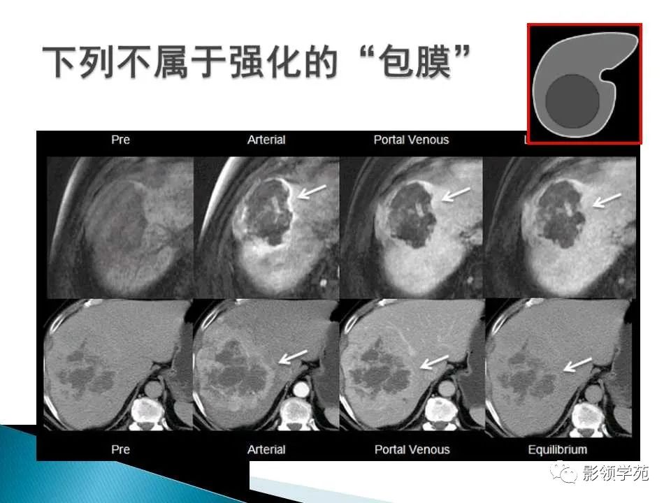 影像PPT - 【PPT】HCC影像诊断进展-47