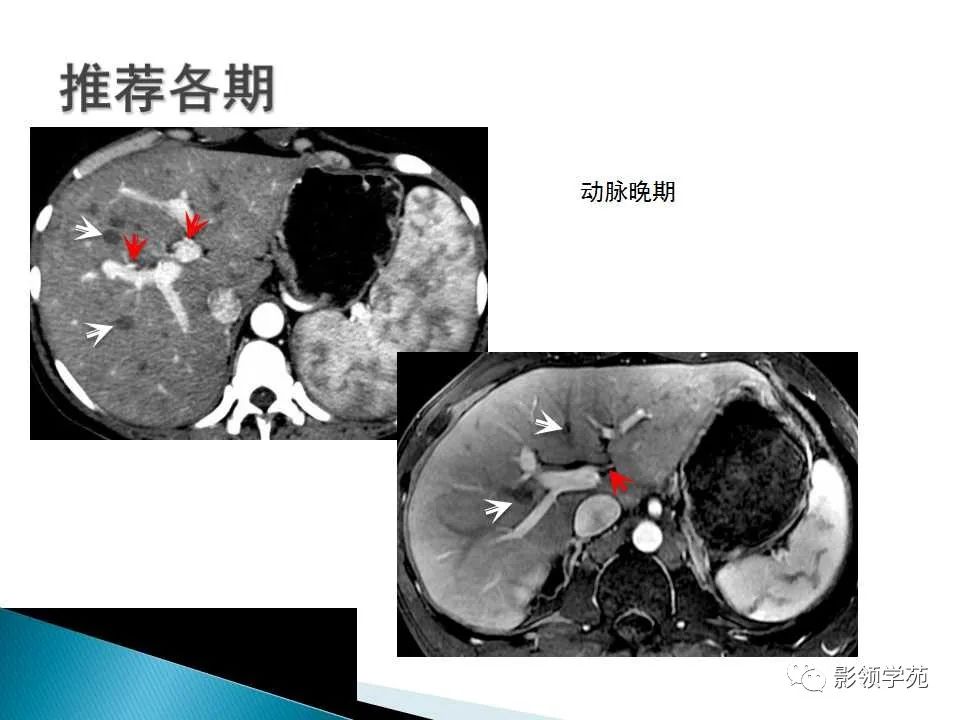 影像PPT - 【PPT】HCC影像诊断进展-52