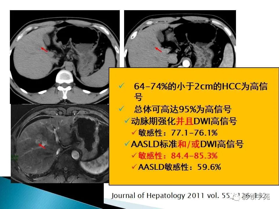 影像PPT - 【PPT】HCC影像诊断进展-59
