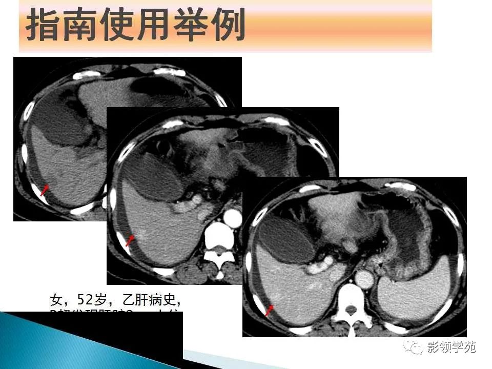 影像PPT - 【PPT】HCC影像诊断进展-69