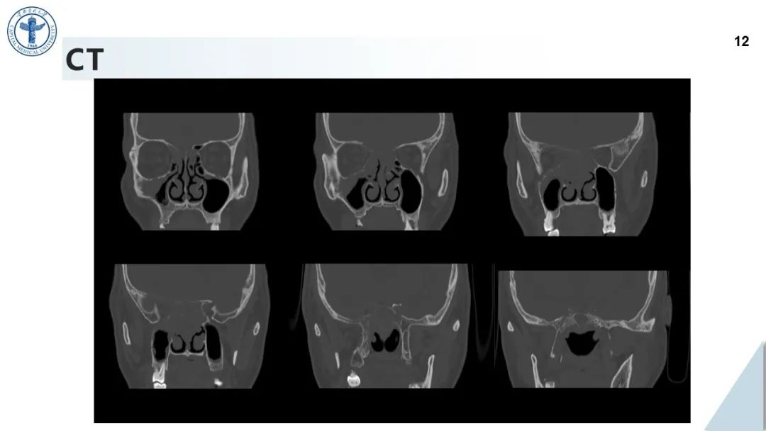 影像PPT - 【病例】鼻中隔腺样囊性癌1例CT及MR影像-11