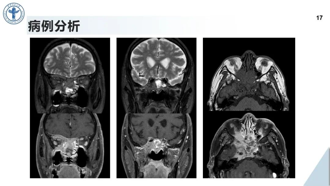 影像PPT - 【病例】鼻中隔腺样囊性癌1例CT及MR影像-16