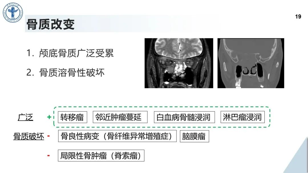 影像PPT - 【病例】鼻中隔腺样囊性癌1例CT及MR影像-18