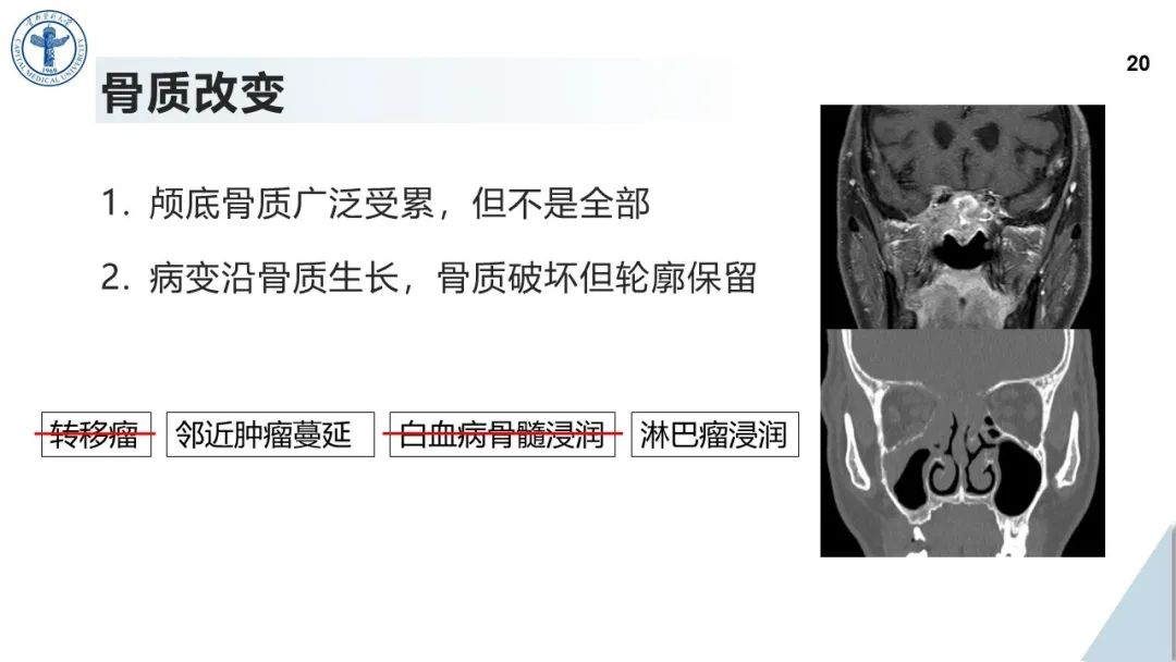 影像PPT - 【病例】鼻中隔腺样囊性癌1例CT及MR影像-19