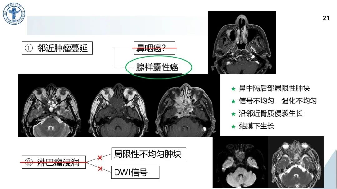 影像PPT - 【病例】鼻中隔腺样囊性癌1例CT及MR影像-20